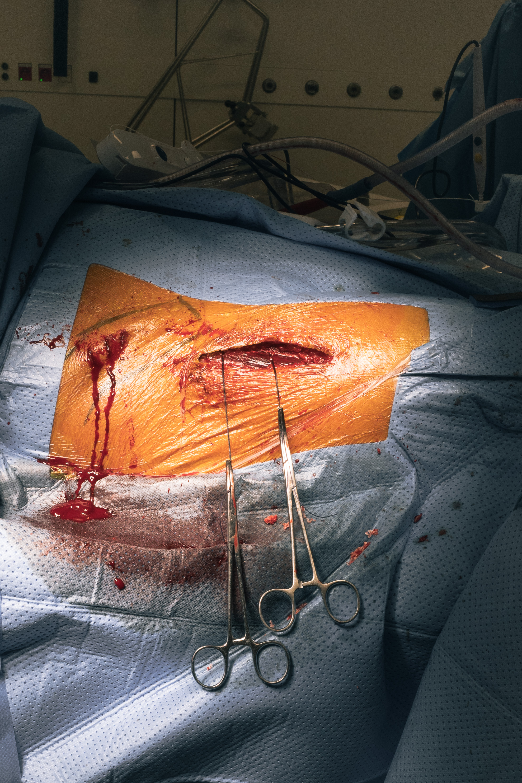 3 months in a surgery room.